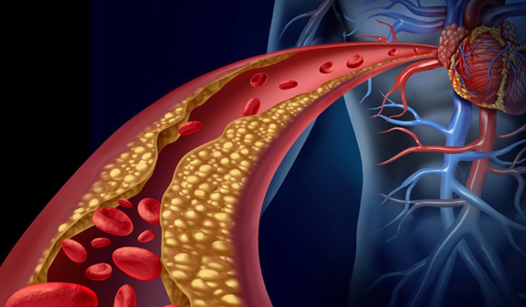 What Is Vascular Calcification?